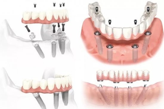 Имплантация зубов "Все на четырех" или All on 4
