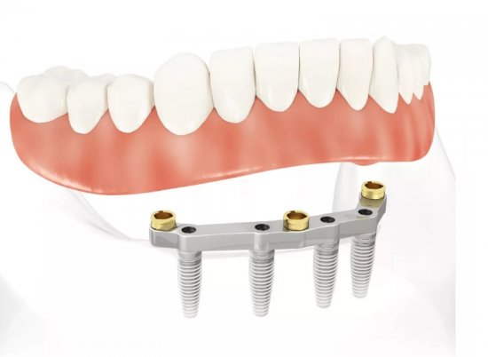 Имплантация зубов "Все на четырех" или All on 4