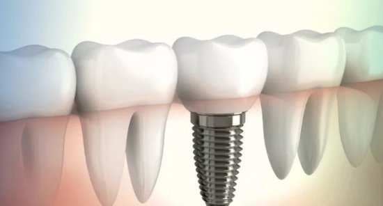 Почему стоит сделать имплантацию зубов